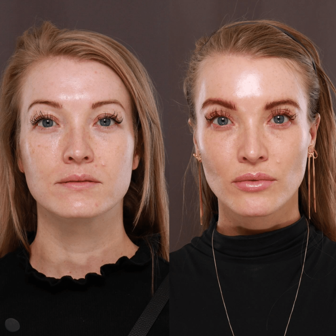 Full-face dermal filler result by Alfie Symes, NP