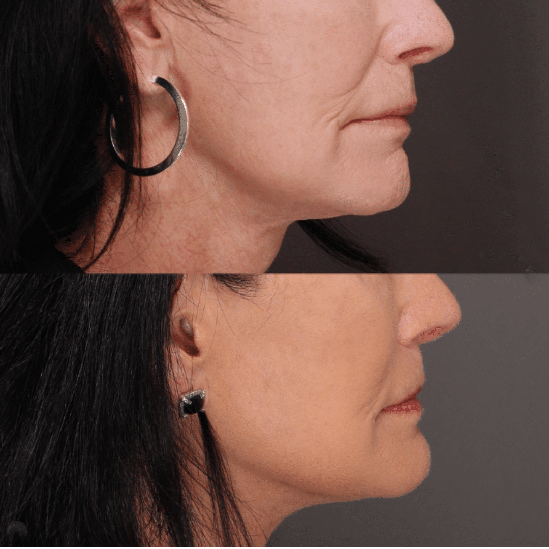 Botox®, filler and Sculptra® result by Trista Mann, RN