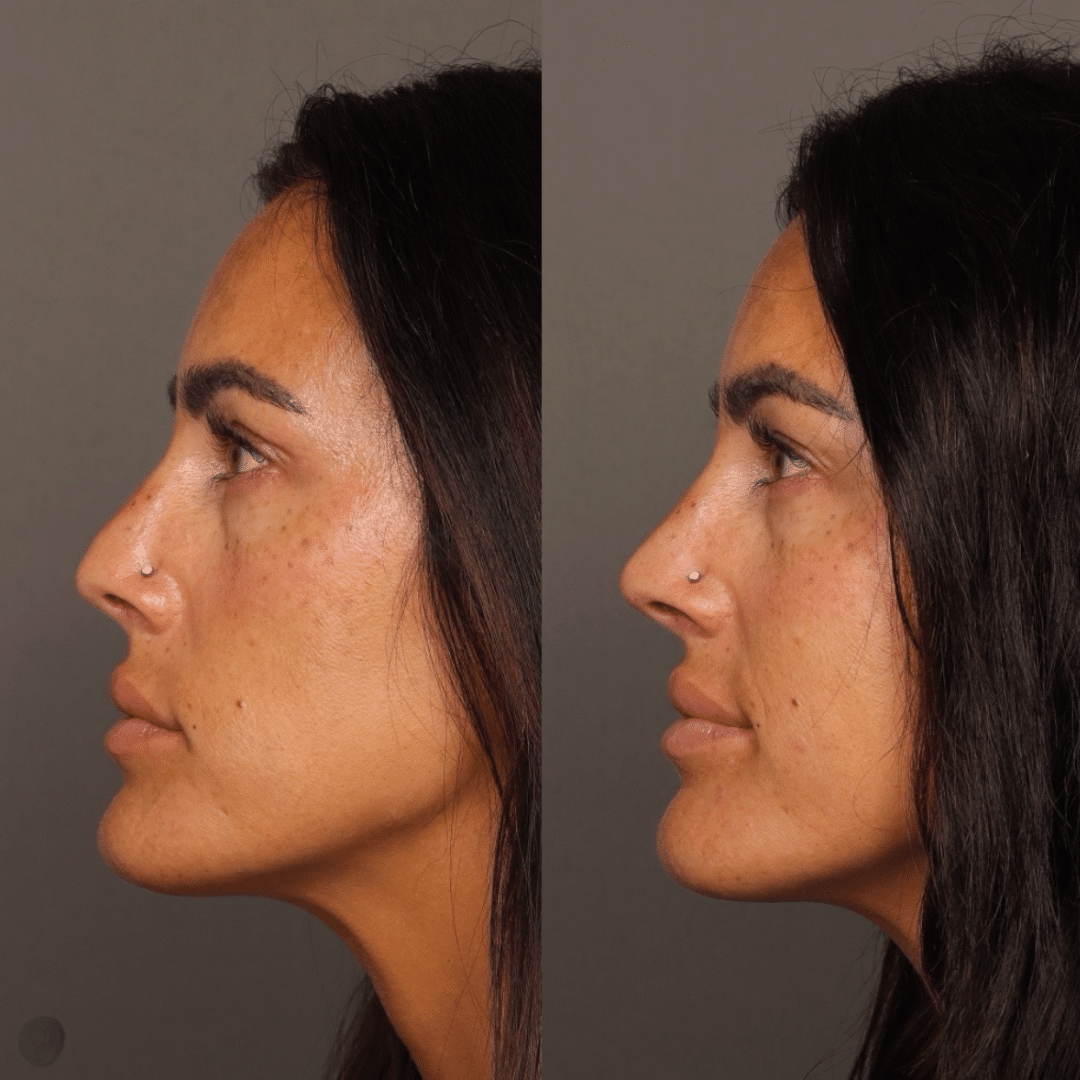 Liquid rhinoplasty result by Alfie Symes, NP