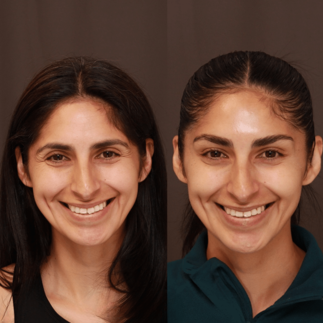 Botox®, upper face result by Trista Mann, RN