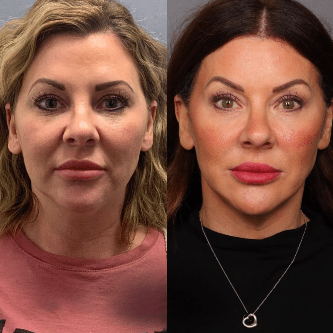 Six years of Sculptra®, filler and Botox® result by Alfie Symes, NP