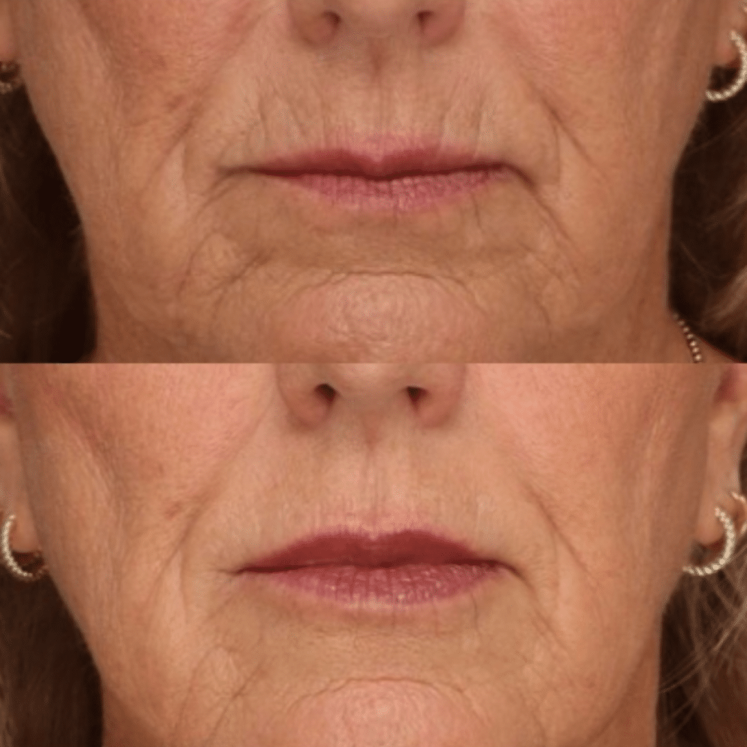 Vollure®, SKINVIVE™ and a Botox® lip flip result by Trista Mann, RN
