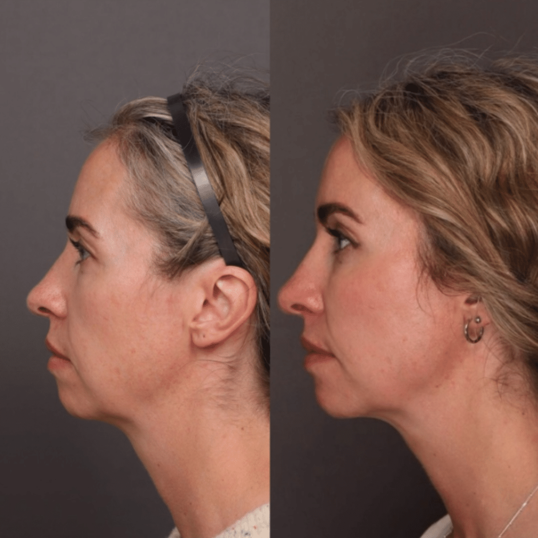 Cheek, temple, jawline and chin filler result by Trista Mann, RN