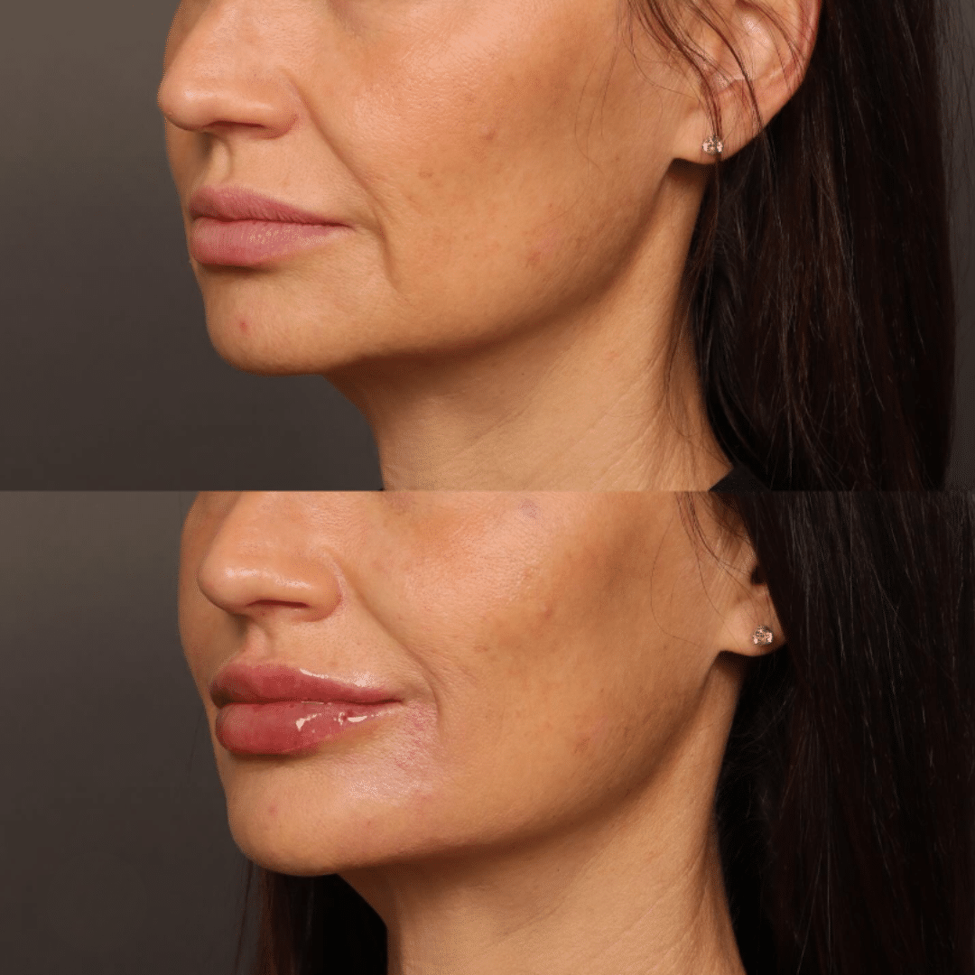 Lip, chin and jawline result by Alfie Symes, NP