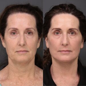 Before Image: Facelift, Buccal Fat Removal & Laser Skin Resurfacing