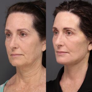 After Image: Facelift, Buccal Fat Removal & Laser Skin Resurfacing
