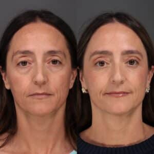 Before Image: Lower Blepharoplasty, Fat Grafting & Laser Skin Resurfacing