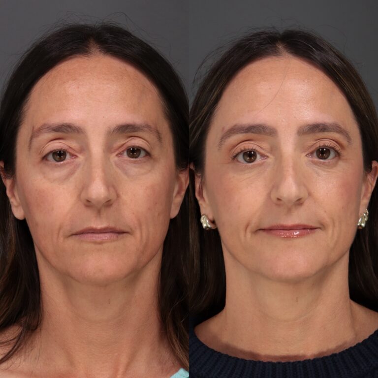 Before Image: Lower Blepharoplasty, Fat Grafting & Laser Skin Resurfacing - front