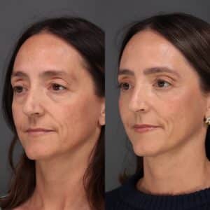 After Image: Lower Blepharoplasty, Fat Grafting & Laser Skin Resurfacing