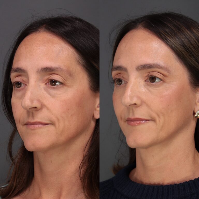 After Image: Lower Blepharoplasty, Fat Grafting & Laser Skin Resurfacing - front