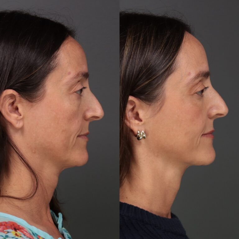 After Image: Lower Blepharoplasty, Fat Grafting & Laser Skin Resurfacing - front