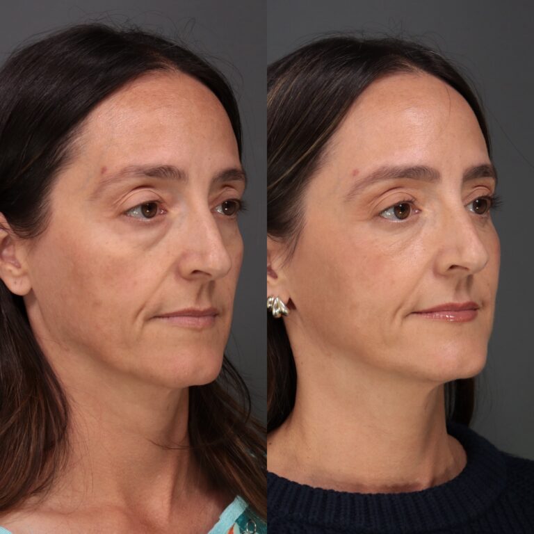 Before Image: Lower Blepharoplasty, Fat Grafting & Laser Skin Resurfacing - front