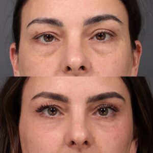 After Image: Lower Blepharoplasty, Fat Grafting & Laser Skin Resurfacing