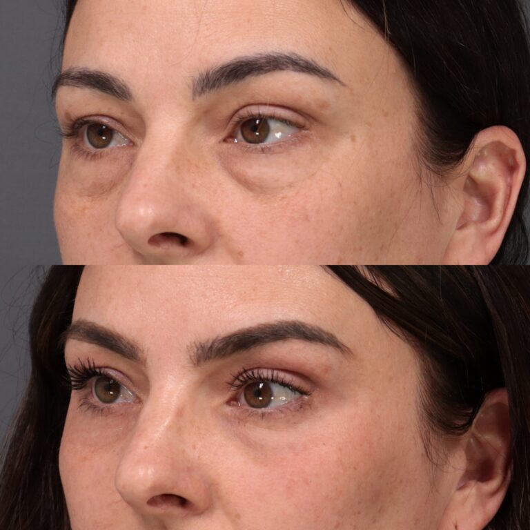 Imagen posterior: Blefaroplastia inferior, injerto de grasa y rejuvenecimiento cutáneo con láser - frontal