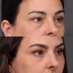 Before Image: Lower Blepharoplasty, Fat Grafting & Laser Skin Resurfacing