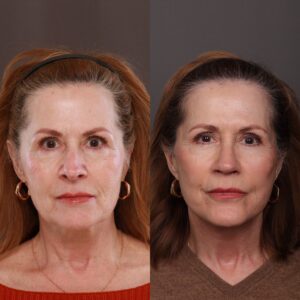 Before Image: Facelift & Fat Grafting with Rhinoplasty