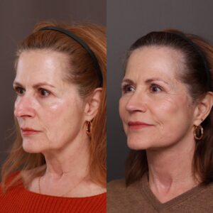 After Image: Facelift & Fat Grafting with Rhinoplasty