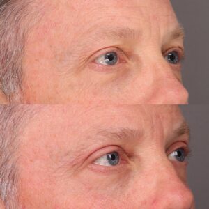 After Image: Upper Blepharoplasty