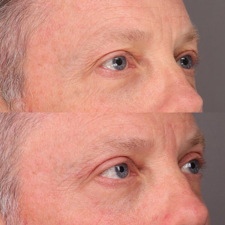 After Image: Upper Blepharoplasty - front