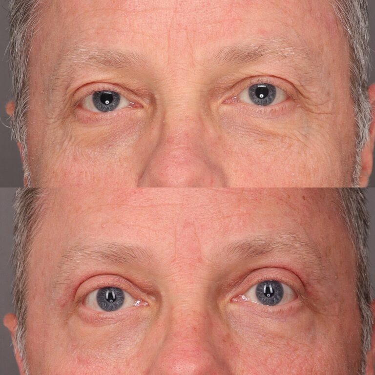 Before Image: Upper Blepharoplasty - front