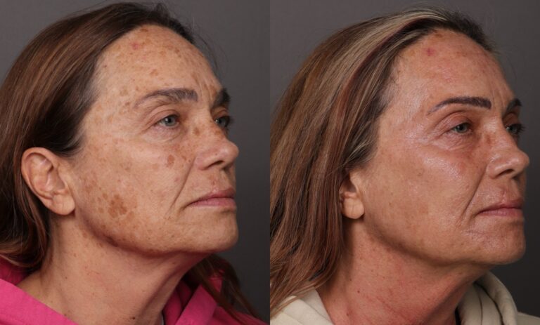 After Image: BBL HEROic & Moxi Treatments - front