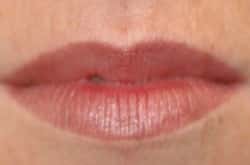 Lip Augmentation Patient 42646