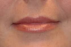 Lip Augmentation Patient 41714