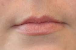 Lip Augmentation Patient 41714