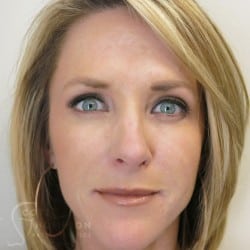 Non-Surgical Facelift Before and After Photos Patient 53