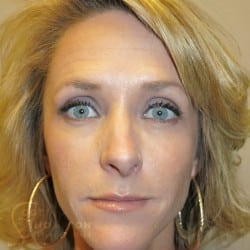 Non-Surgical Facelift Before and After Photos Patient 53