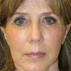 Non-Surgical Facelift Before and After Photos Patient 87