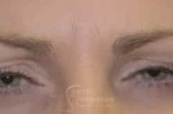 After Image: Botox - front