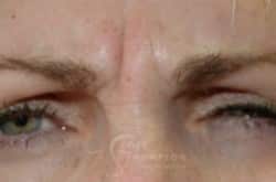 Before Image: Botox - front