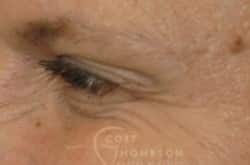 After Image: Botox - other