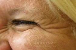 Before Image: Botox - other