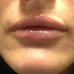 Lip Augmentation – 454