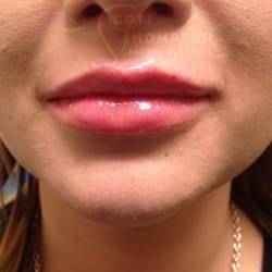 Lip Augmentation – 455