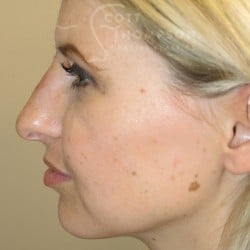 Non-Surgical Rhinoplasty – 899