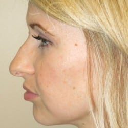 Non-Surgical Rhinoplasty – 899