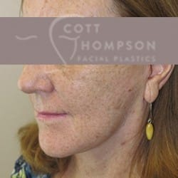 MACS Facelift Before and After Photos | Utah Facial Plastics 210