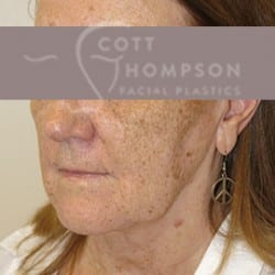 MACS Facelift Before and After Photos | Utah Facial Plastics 210