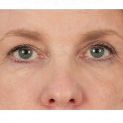 Non-Surgical Tear Trough Rejuvenation by Dr. Henstrom