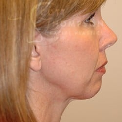 MACS FACELIFT & Chin Implant BEFORE AND AFTER PHOTOS | UTAH FACIAL PLASTICS 202