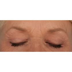 Upper Eyelid Surgery by Dr. Henstrom