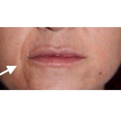 Smile Lines with Juvederm