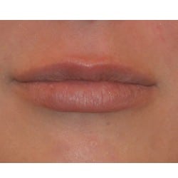 Lip Augmentation