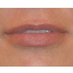 Lip Augmentation