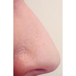 Non-Surgical Rhinoplasty by Alfie Symes