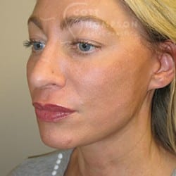 MACS Facelift Before and After Photos | Utah Facial Plastics 503