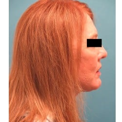 Facelift, Fat Transfer, Upper & Lower Eyelids, Perioral Dermabrasion by Dr. Henstrom